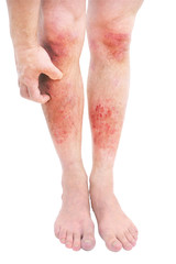 Atopic dermatitis (AD), also known as atopic eczema, is a type of skin inflammation (dermatitis) .