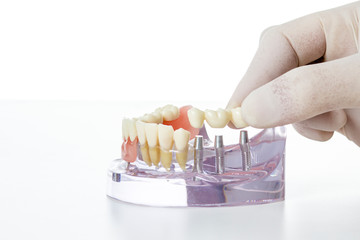 preparation of dental prosthesis