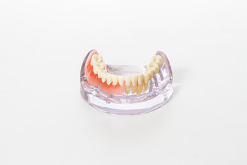 preparation of dental prosthesis