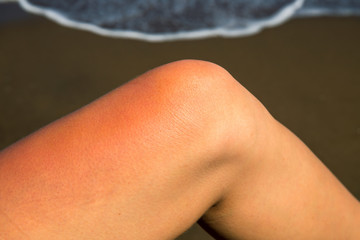 Woman leg with red sunburn skin on seaside background. Sunburned skin redness and irritation. Dangerous sun
