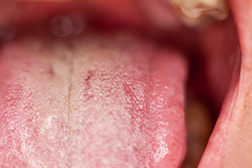 Fototapeta premium medicine, what the tongue says, white bloom on the tongue close-up