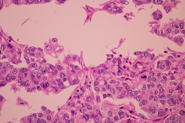 Fototapeta na wymiar View in microscopic of pathology cross section tissue ductal cell carcinoma or adenocarcinoma diagnosis by pathologist in laboratory.H and E stain.Criteria of breast cancer.Medical concept
