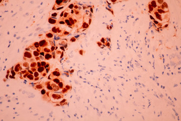 View in microscopic of pathology cross section tissue ductal cell carcinoma or adenocarcinoma...