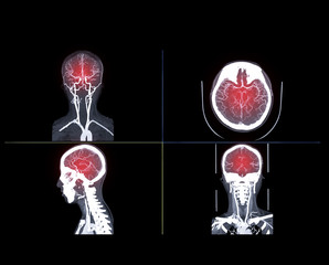  CTA brain or CT angiography of the brain  comparison Coronal and Sagittal view fusion 2D and 3D Rendering image . medical technology concept.