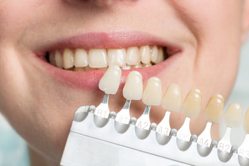 Close up of dentist using shade guide at woman's mouth to check veneer of teeth for bleaching.