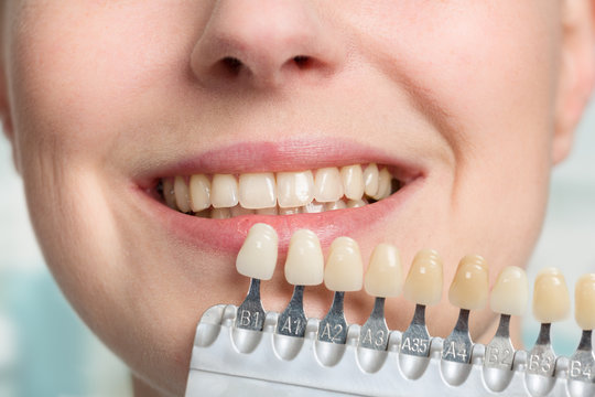 Close up of dentist using shade guide at woman's mouth to check veneer of teeth for bleaching.