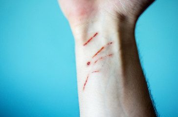 Hand after cat scratch,isolated on blue background