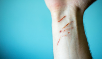 Hand after cat scratch,isolated on blue background