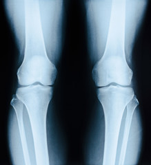 x-ray image patient with degenerative change of knee joint.