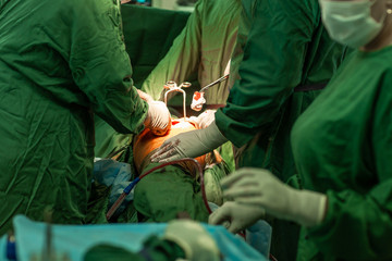 Orthopedic surgeons in teamwork, hip replacement in the operating room
