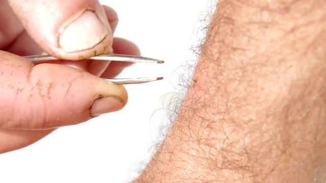 tick bite on human arm