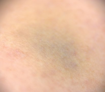 h&eacute;matome bleu sur peau en gros plan 