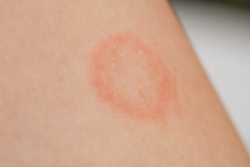 Mycosis infection on the human skin. It is caused by a fungus