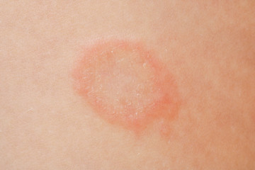 Mycosis infection on the human skin. It is caused by a fungus