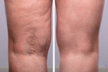 Treatment Of Varicose Before And After - obrazy, fototapety, plakaty