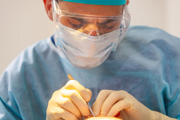 Baldness treatment. Hair transplant. Surgeons in the operating room carry out hair transplant...
