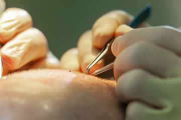 Macrophotography of a hair bulb transplanted into a hairless area. Baldness treatment. Hair...