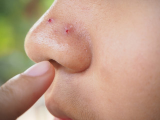 finger pointing acne scar on nose woman cause of squeeze pimple.