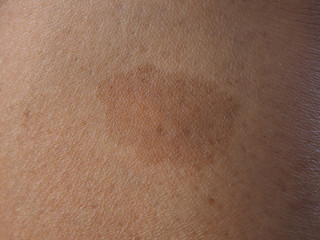 dark brow birthmark or cafe au lait ma or CLAMs on the skin leg woman using for health care and...