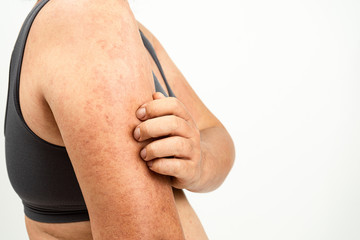 Urticaria.
