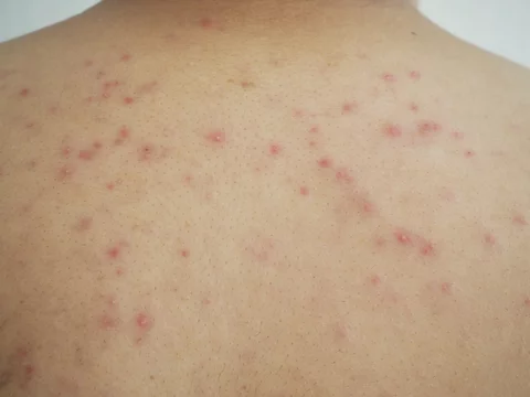 heat rash or prickly heat or miliaria on the back skin asian man