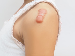keloid scar of skin shoulder kid girl case of tissue forms over the wound to repair and larger than...