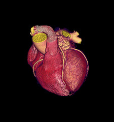 CTA Coronary artery  3D rendering image for finding coronary artery disease.