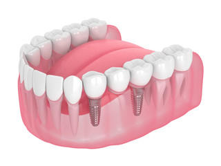 3d render of jaw with implants supported dental bridge