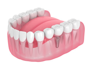 3d render of jaw with implant supported dental cantilever bridge