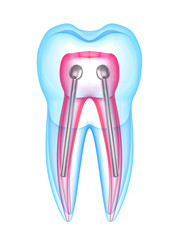 3d render of x-ray tooth with stainless steel dental post