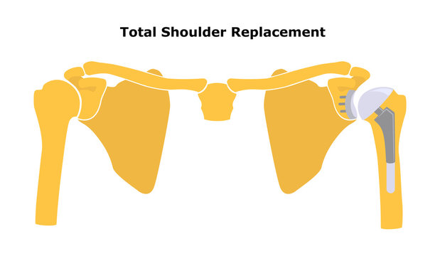 Total Shoulder Replacement. Shoulder joint replacement, endoprosthetics. Osteoarthrosis of the shoulder joint. Vector illustration. Flat design.