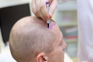 Baldness treatment. Patient suffering from hair loss in consultation with a doctor. Preparation for hair transplant surgery. The line marking the growth of hair. The patient controls the marking in - obrazy, fototapety, plakaty