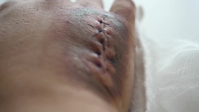 Huge satured blody bruised wound on the hand