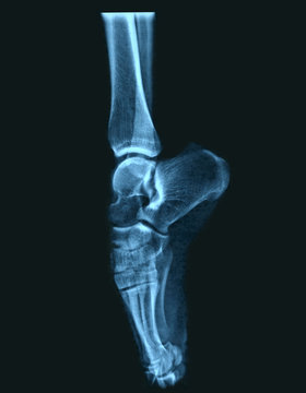 X-Ray Of A Ballet Dancer's Foot.