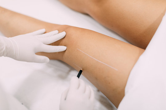 Laser treatment for skin resurfacing at spa center
