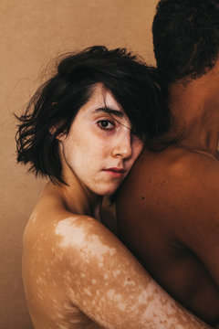 Vitiligo skin girl