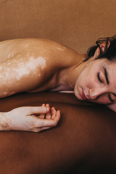 Vitiligo skin girl