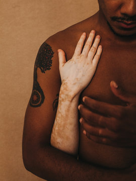 Vitiligo skin girl