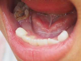 Open mouth showing teeth caries or tooth decay of lower molar
