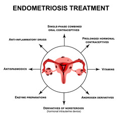 Treatment of endometriosis. Adenomyosis. The structure of the pelvic organs with endometriosis. Infographics. Vector illustration on isolated background.
