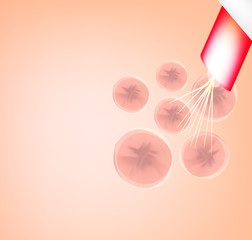 Skin scars after acne and pimples. Treatment of scars on the skin of the face with a laser. Infographics. Vector illustration on isolated background.