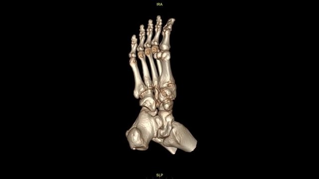 CT Scan of foot with 3D rendering technic.