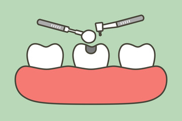 step of tooth amalgam filling by dental tools to protection decay tooth - teeth cartoon vector flat style