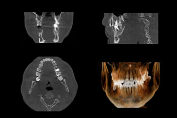 Set of MRI scanner slices of dental part of human male scull with multiple problems on white background. 