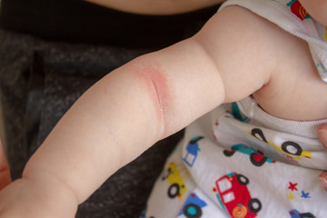 Prickly heat. Close-up of the folds of the hand of a newborn baby with red skin. 
