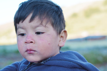 Sad little latin boy with injured skin.