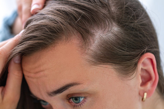 Woman suffering from hair loss. Treatment of hair problems
