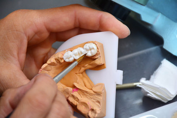 Zahntechnik Prothese mit Keramik schichten