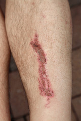 Sch&uuml;rfwunde nach einem Unfall