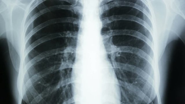 Vertical tracking, of a X-ray plate of the human thorax.